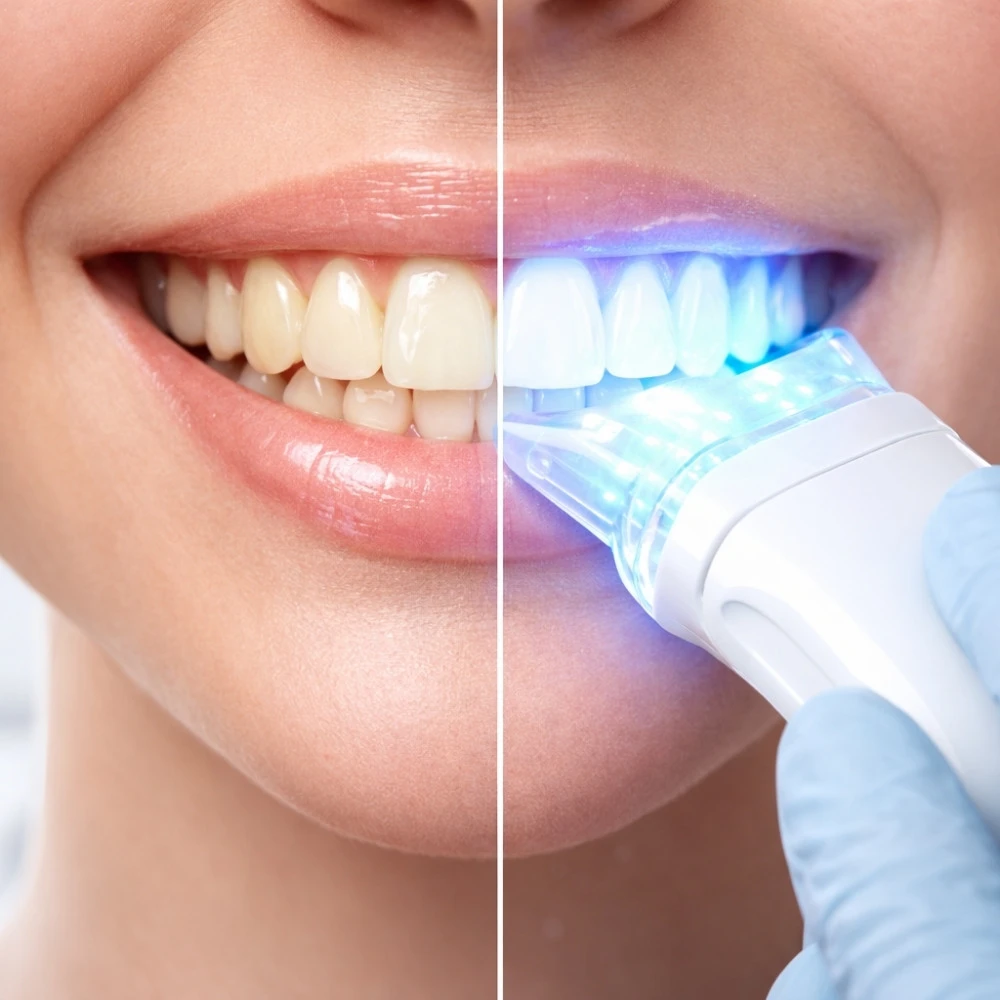 Diş Beyazlatma