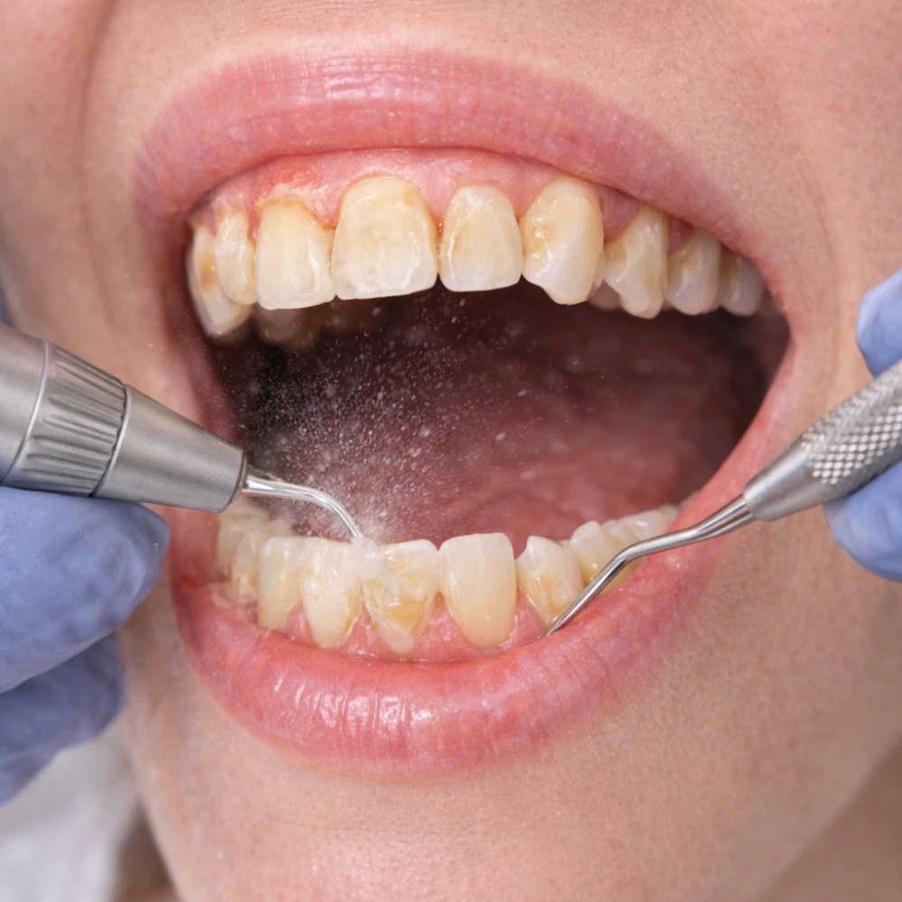 Diş Taşı Temizliği ve Diş Eti Tedavileri