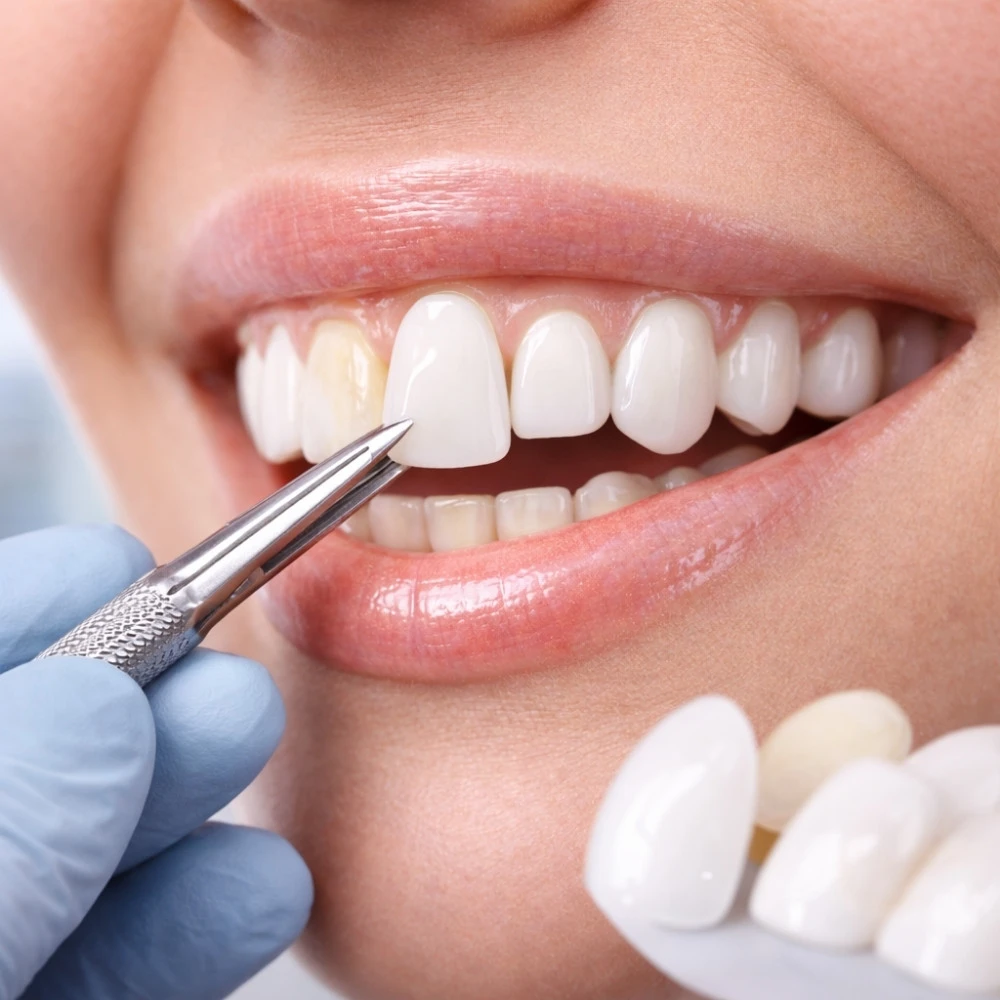 Lamina Veneer (Yaprak Porselen)