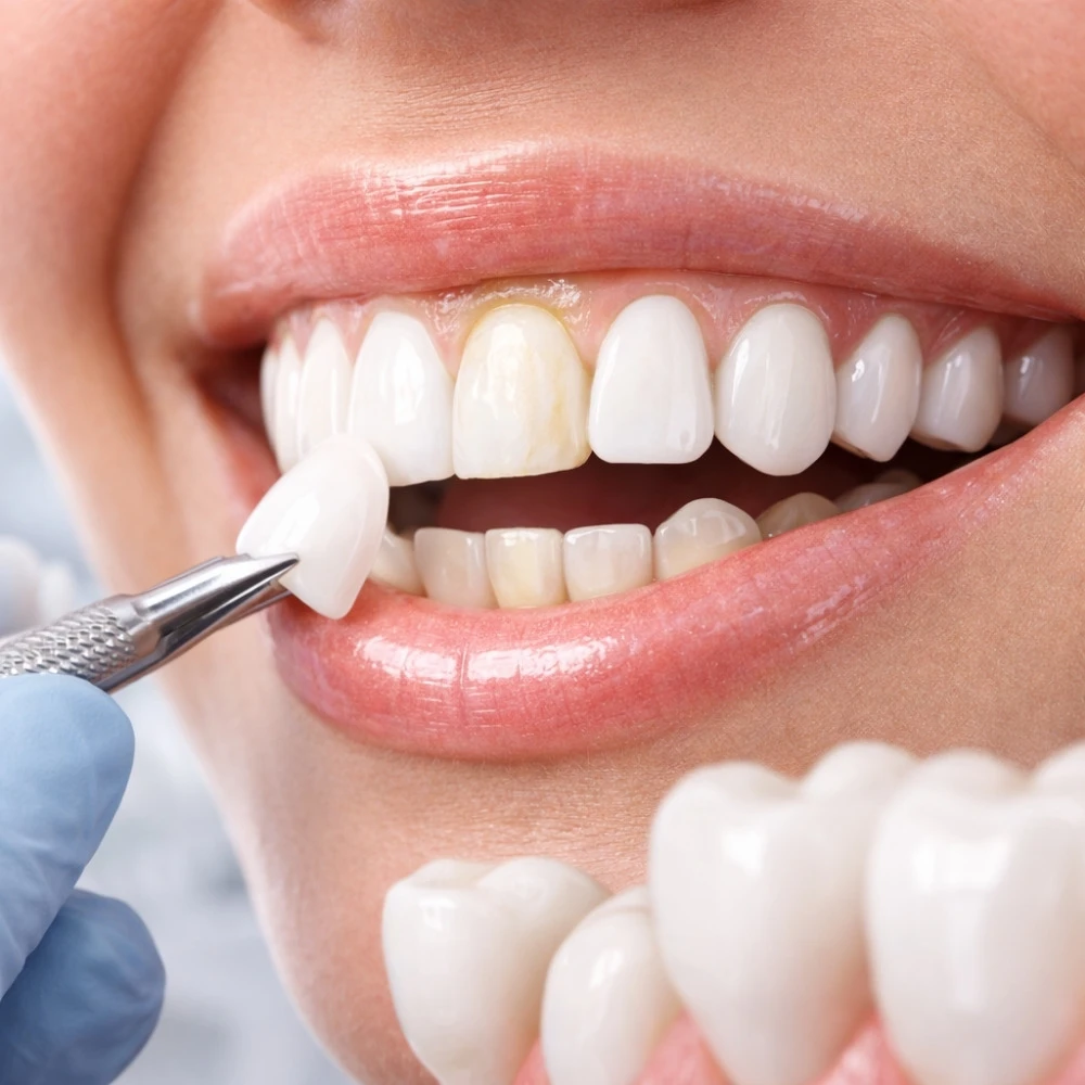 Zirkonyum ve Porselen Kaplama